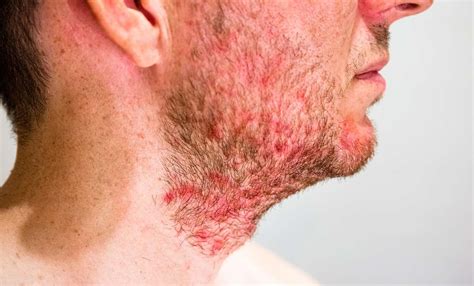Seborrheic Dermatitis Rough Red Rash On The Face
