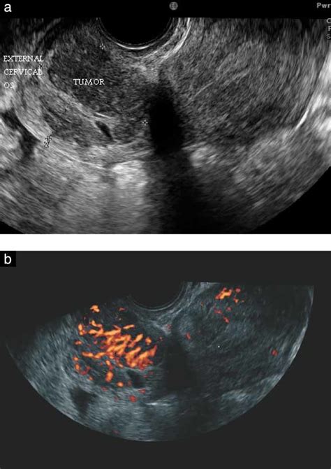 Sonographic Characteristics Of Squamous Cell Cancer And Adenocarcinoma