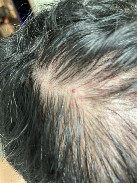 What Is This Bump On My Scalp Rdermatologyquestions