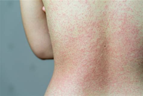 Covid Rash Adults Naturopathic Doctor News And Review The Voice Of