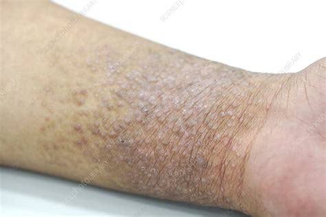 Eczema Stock Image F0324067 Science Photo Library