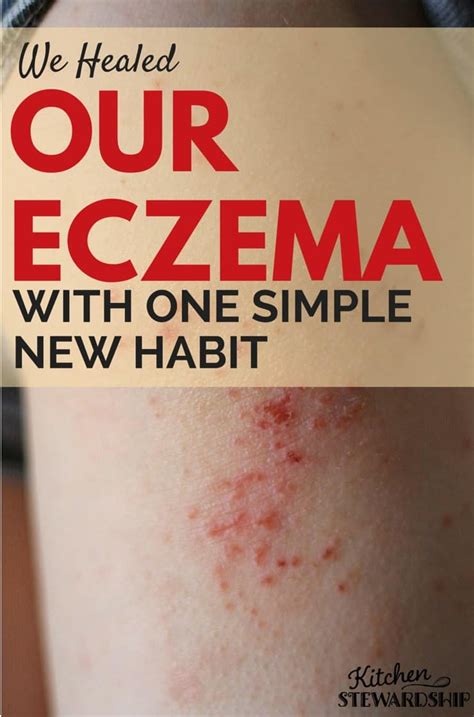 Stop The Itch Identify Triggers And Treat Eczema Naturally Natural