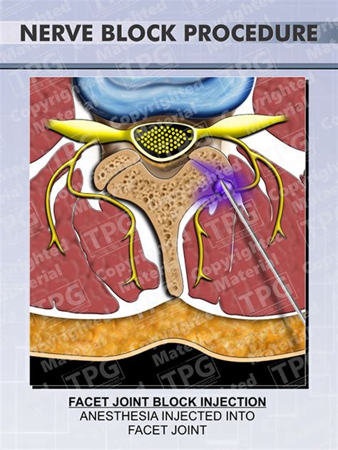 Facet Joint Nerve Block Injection