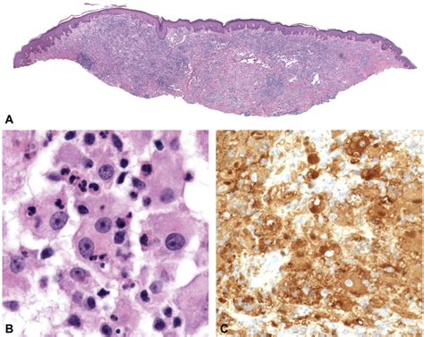 Histopathologic Features Of Cutaneous Rosai Dorfman Disease A A Dense