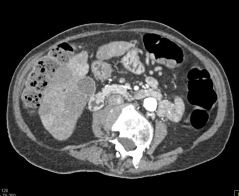 Pancreatic Adenocarcinoma With Liver Metastases And Left Femoral Vein