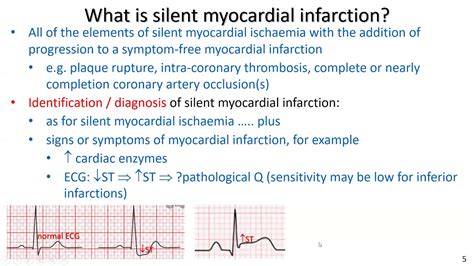 “silent” Myocardial Ischaemia And “silent” Myocardial Infarction For
