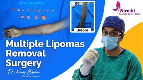 Multiple Lipomas Removal Surgery By Dr Neeraj Bhaban Youtube