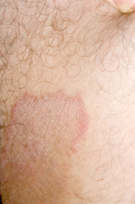 Ringworm Stock Image M2700327 Science Photo Library