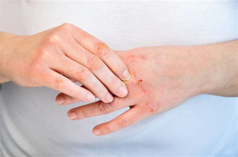 How To Beat Hand Dermatitis Due To Frequent Handwashing Skincare