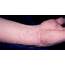 HEALTH FROM TRUSTED SOURCES Scabies