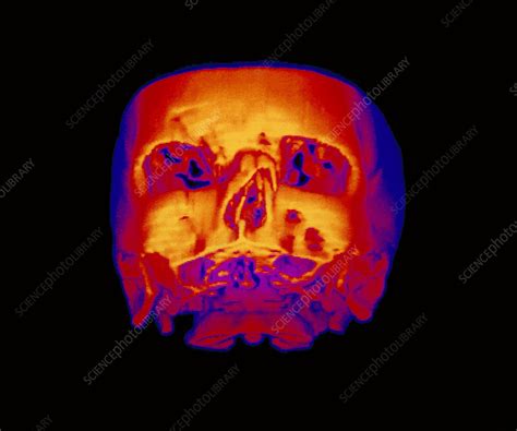 False Colour 3 D Ct Scan Of Broken Nasal Bone Stock Image M3300245