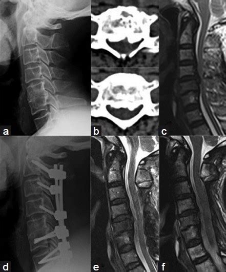 A 66 Year Old Man With A Continuous Cervical Opll Involving Multiple