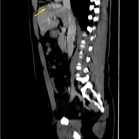 Axial Views Of A Contrast Enhanced Ct Scan Of The Liver Revealing A