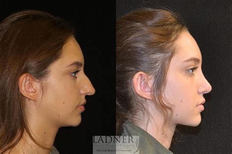 Rhinoplasty Nose Job In Denver Colorado Ladner Facial Plastic Surgery Keith Ladner MD