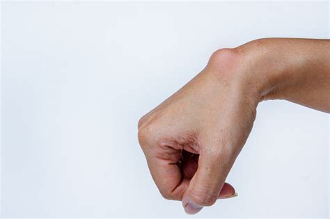 Ganglion -Wrist | Connecticut Orthopaedics