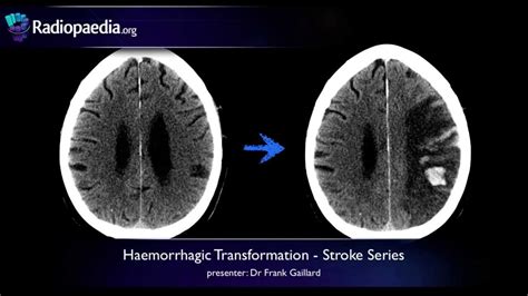 Hemorrhagic Stroke Mri