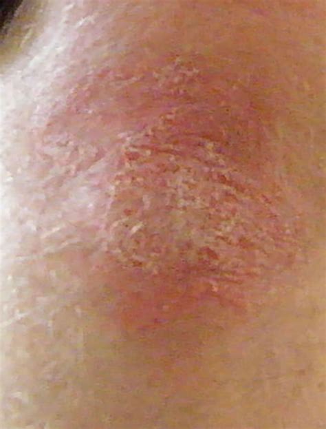 Skin Cancer Skin Cancer Knee