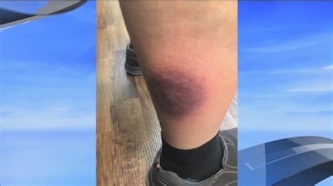 Michigan Man Recovering From Brown Recluse Spider Bite Wnem Tv 5