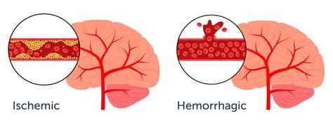 Ischemic Stroke Vs Hemorrhagic Stroke