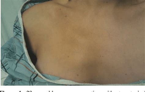 Figure 1 From Tietzes Syndrome In The Emergency Department A Rare