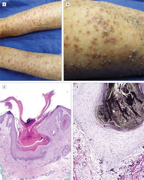 An Unusual Follicular Eruption In A Young Adult With New Onset Type I