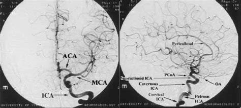 Cerebral Angiogram Anatomy