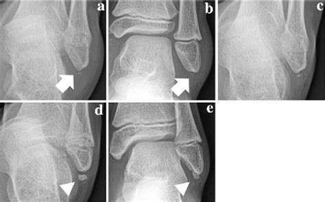 Acute Distal Fibula Fracture Denmedi