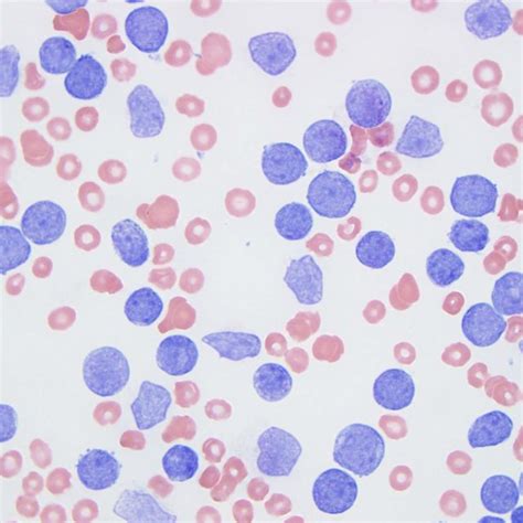 The Peripheral Blood Smear Showed Marked Leukocytosis With