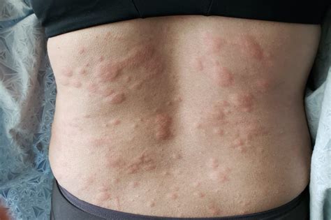 Learn about shock, symptoms, treatment, diagnosis, causes (insect stings, latex allergy, food allergy, medication allergy). Anaphylaxis: symptoms, causes and diagnosis - The ...