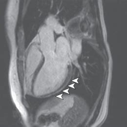 Bei der diagnose einer herzmuskelentzündung kommen verschiedene untersuchungsmethoden aufgrund der unspezifischen symptome ist die diagnose myokarditis nicht immer einfach zu stellen. MRT-Studie: Corona könnte dem Herzen langfristig schaden