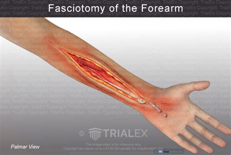 Fasciotomy Of The Forearm Trialexhibits Inc