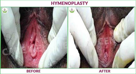 Cost Of Hymenoplasty In Delhi Virginity Surgery Care Well Medical Centre