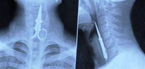 Inside Story Weird Objects And Horrifying Injuries Caught On X Ray
