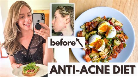 Anti Acne Diet What I Eat In A Day For Hormonal Acne Youtube