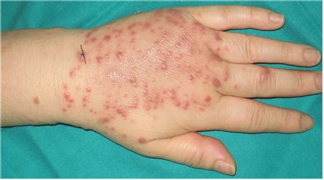 Multiple Erythematous Violaceous Papules Of 3 4 Mm On The Back Of The