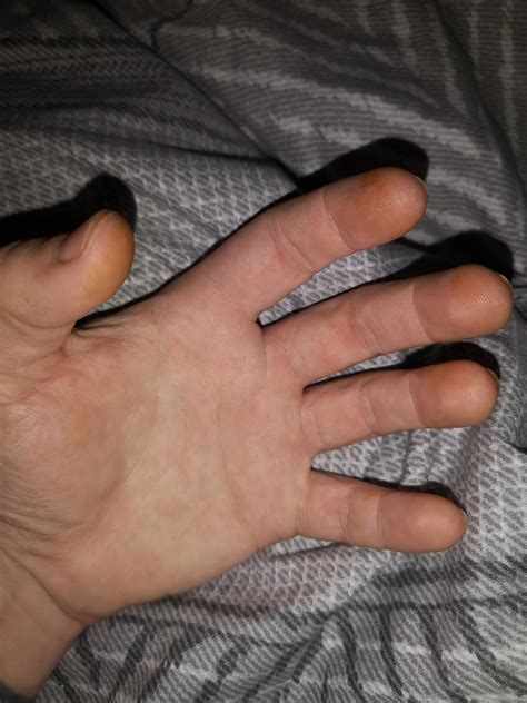 Fingertips Are Turning Orange Orange Spots On Hands Too Why Medical