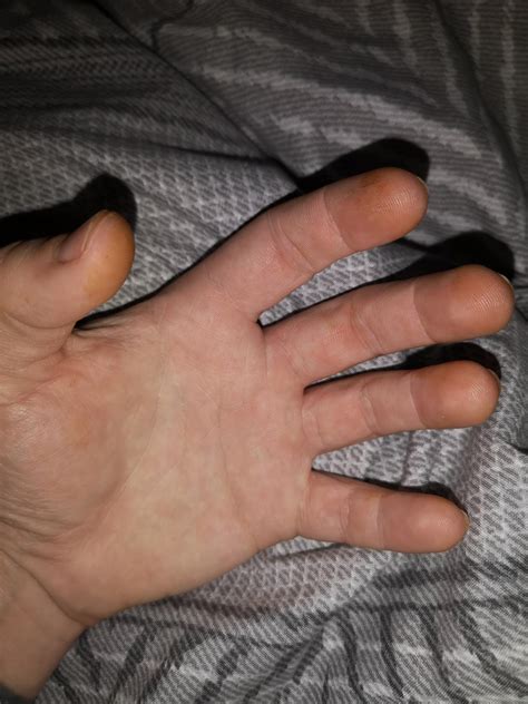Fingertips are turning orange. Orange spots on hands too. Why? : r/medical