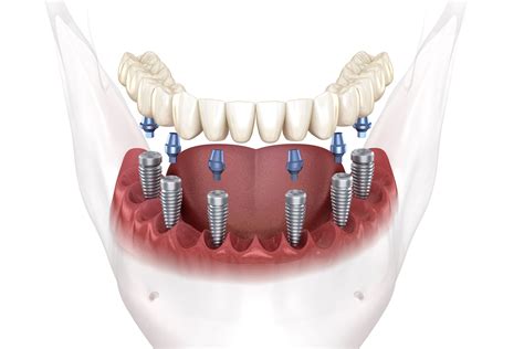 Full Mouth Dental Implants Phoenix Az Missing All Teeth