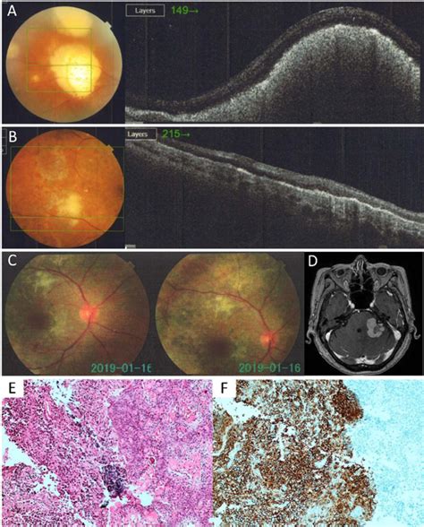 Scielo Brasil Primary Intraocular Lymphoma Case Report And