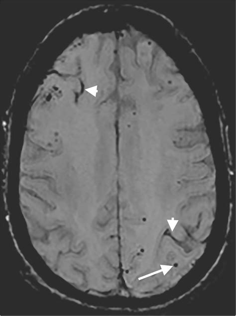 Mri Of A Patient With Cerebral Amyloid Angiopathy Download