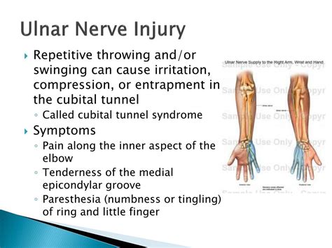 Ulnar Nerve Injury Symptoms