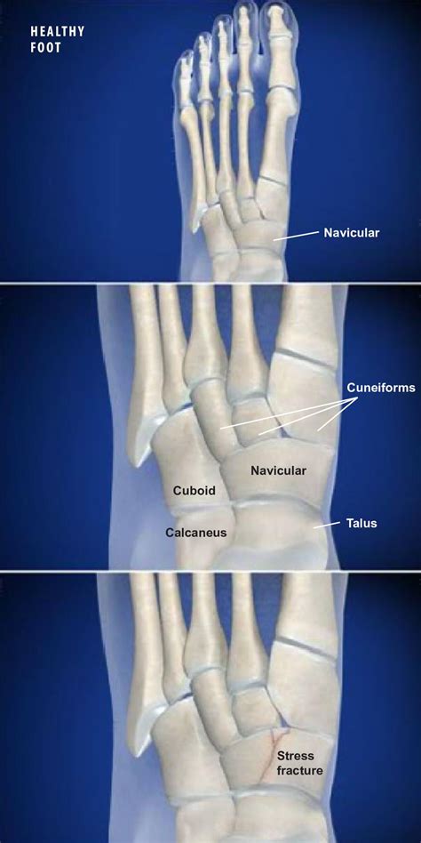 Navicular Fracture