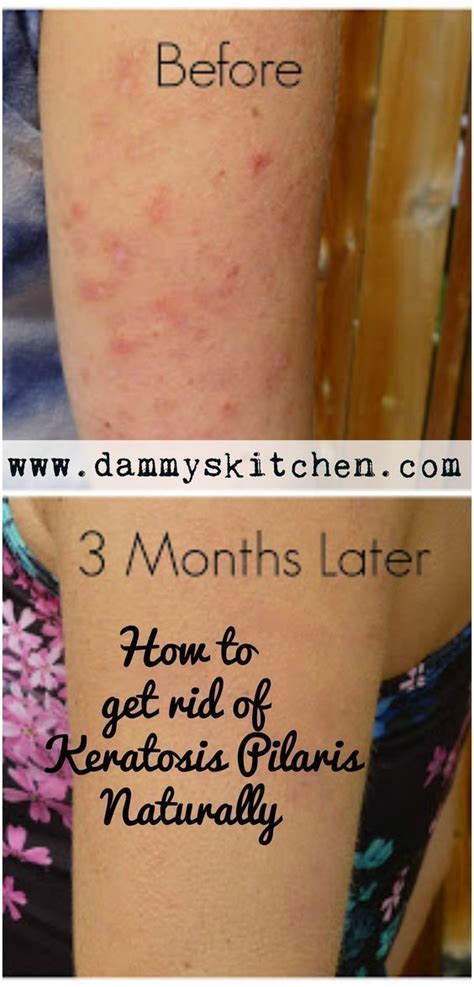 How To Get Rid Of Arm Bumps Aka Keratosis Pilaris Or Chicken Skin