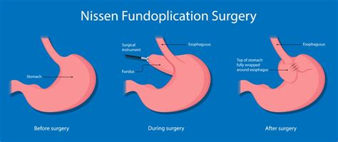 Why Weight Loss Surgery Can Be A Problem After Nissen Fundoplication