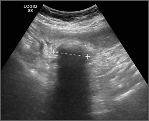 Gallstone Ileus A Multimodality Diagnosis Eurorad