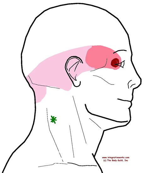 Trigger Points Neckche Headache Eyeache Integrative Works