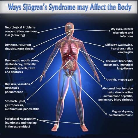 Sjogrens Syndrome Poland Pdf Ppt Case Reports Symptoms Treatment