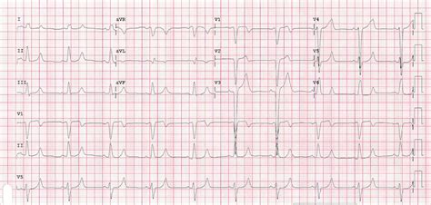 St Elevation Myocardial Infarction In Lbbb Core Em