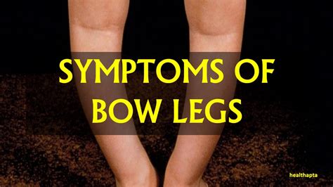 Symptoms Of Bow Legs Youtube