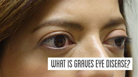 What Is Graves Eye Disease Youtube
